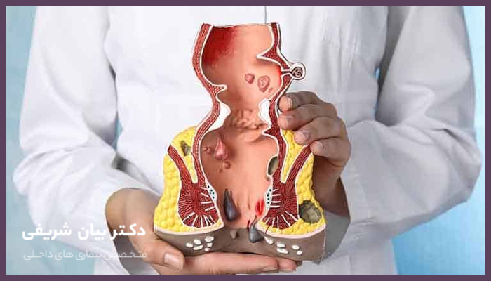 روش های جراحی هموروئید 