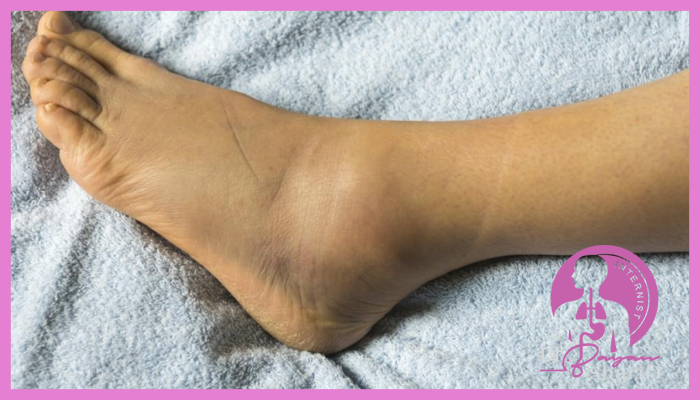 عوارض و خطرات ورم پا در افراد دیابتی